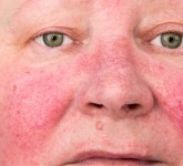 Место системных ретиноидов в лечении розацеа